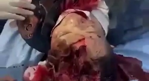 a stone fell on 7th floor landed on mans head creating a massive hole on his skull (probably not gonna live)