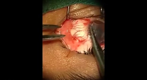 Pterygium Surgery