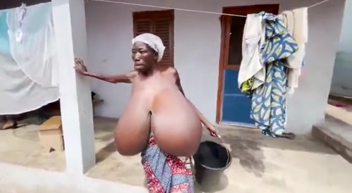 Massive Hypertrophy