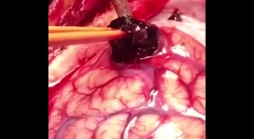 Blood Clot Removal From The Brain