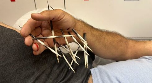 horrible porcupine attack