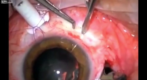 Glass Removal From An Eye