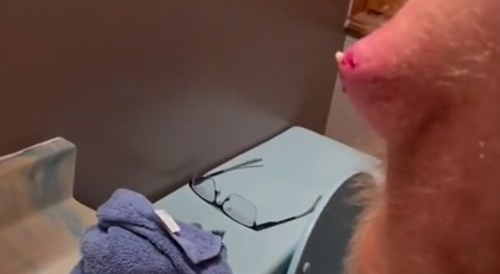 Man Pops Giant Pimple - Gross!