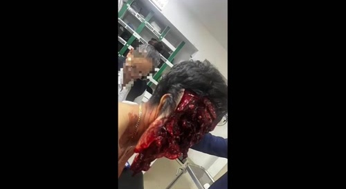 Biker Thrown, Loses Half His Face