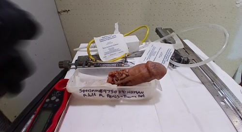Severed penis examined