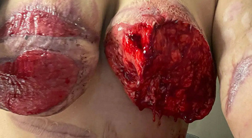 Transgender Body Dysmorphic Disorder