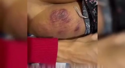 Butt Lift got Infected now Looks like Lasagna Ass