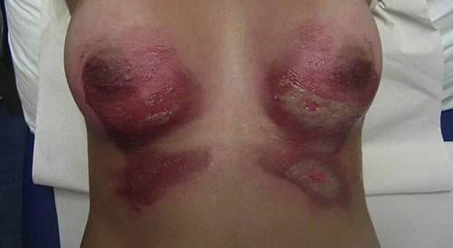 burnt by her own stomach acid