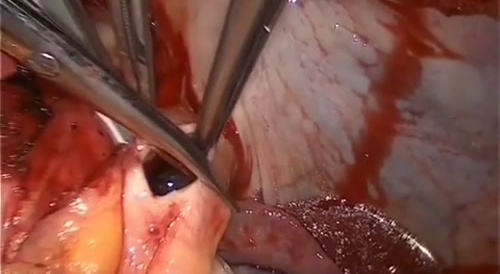 Removal Of Huge Bloodclot From The Heart