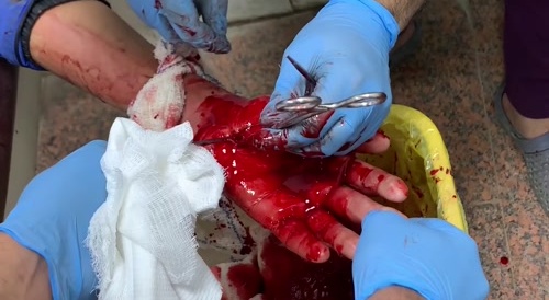 Failed Suicide Attempt Gets Fixed By Drs