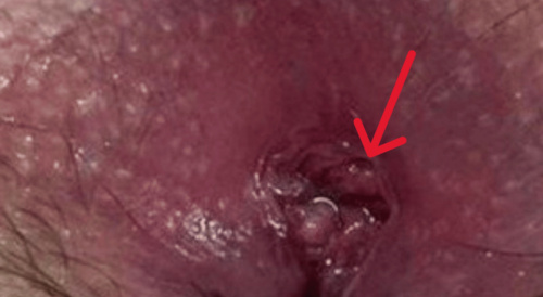 MIX: Duplicated anuses