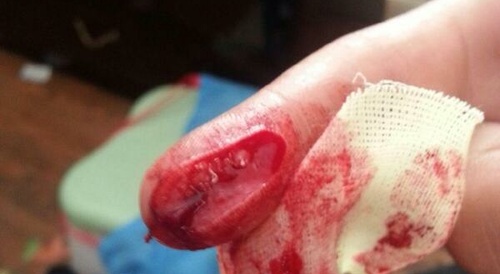 cut on finger