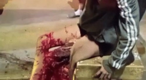 girl legs crushed by truck