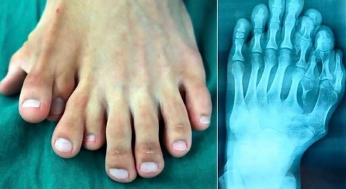 foot with many toes