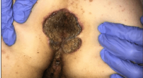 necrotic lesion surrounding butthole