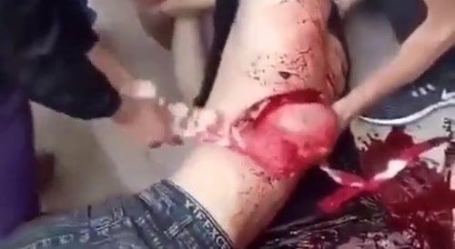 Dude Lungs exposed out by Accident