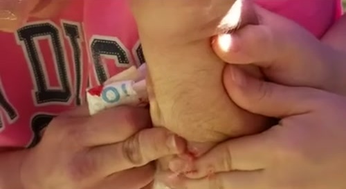 Dude pops a Giant Pimple - like gross!