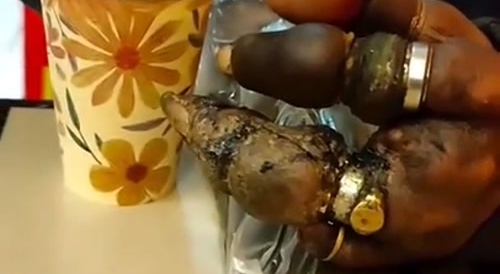 Man's Rotten Fingers about to Fall Off