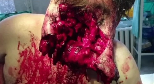 Unsuccessful suicide leaves man faceless