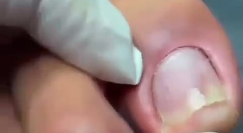 Panaritis, Toe-jam on Steroids