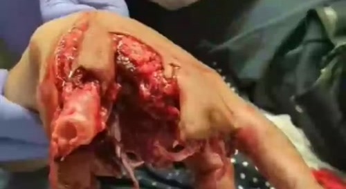 Firework accident #2