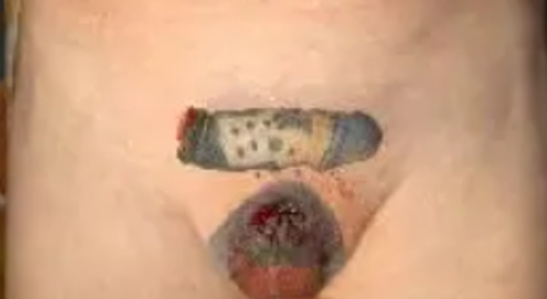 Man Cut's Off His Infected Penis