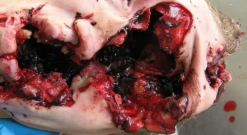 Suicide with shotgun