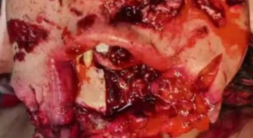 Injury to the jaw and face caused by a heavy object.