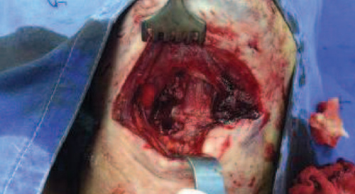 Complex cervical trauma.