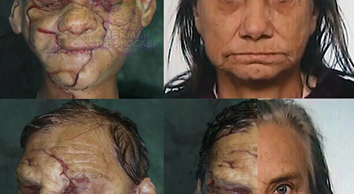 Open Casket Reconstruction