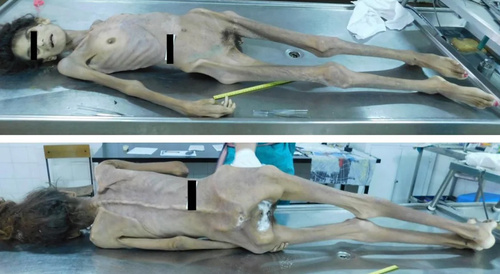 Sudden but not unexpected death in anorexia nervosa.