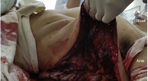 Patient had crush injury to the left side of his chest with associated bowel herniation.