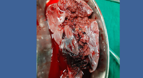 Shattered spleen! Ouch.