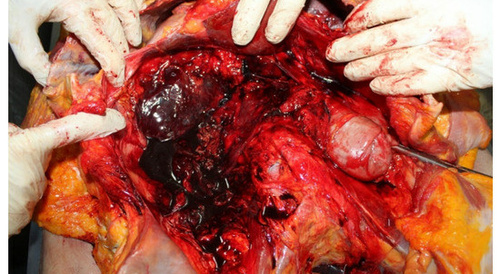 Abdominal trauma, Vertebral fractures.