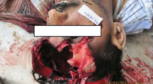 The Kronlein shot (evisceration of the brain)