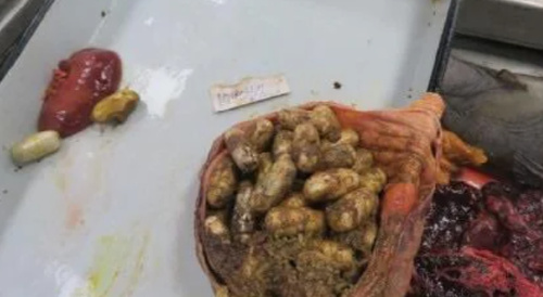 Afghan body packer after death in an Indian motel