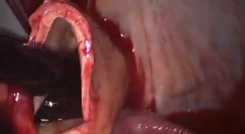 One Huge Pulmonary Embolism!