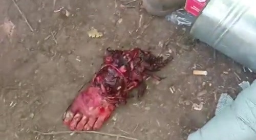 Russian Soldier Shows His Stump