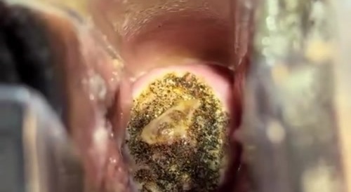 Black Pussy HPV