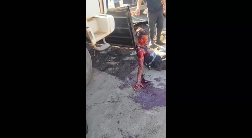 Bleeding After Knife Fight