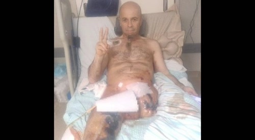 Another Ukrainian lost a leg in the war with Russia.