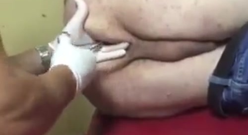 Man Gets A Bottle Of Deodorant Stuck Deep In His Ass Hole