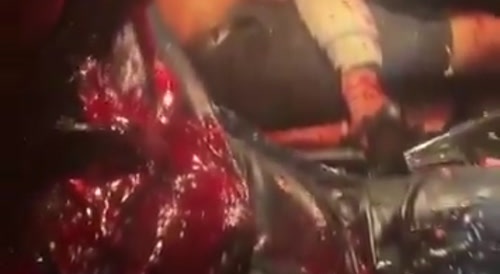 Blood bath
