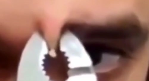 Zit Squeeze