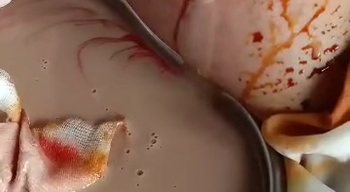 Infected Breast Implant