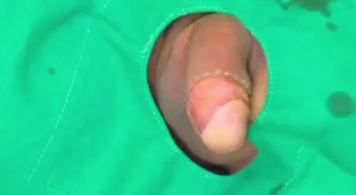 Imagine Doing Your Own Circumcision