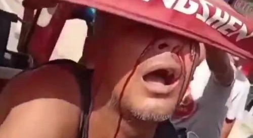 Dude Got Something Stuck In His Eye