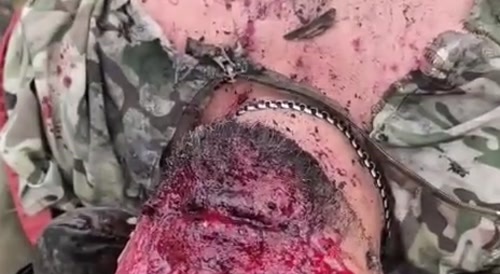 A putinist terrorist had his hands and face blown off.