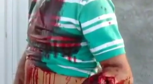 Man Is Calm With A Badly Broken Arm And Deep Lacerations