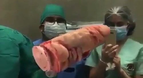 She needed surgery to get it out...